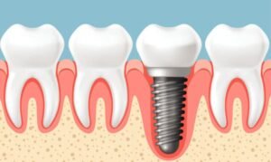 Dental Implants