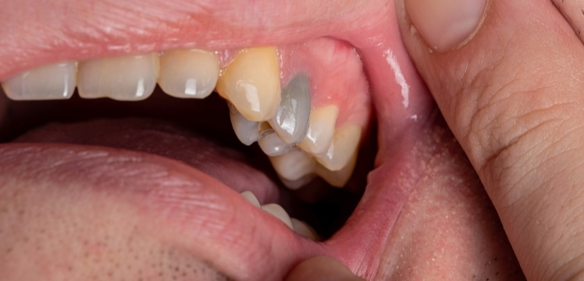 Is A Black Tooth An Emergency